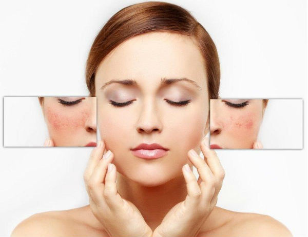 cách điều trị nám hiệu quả