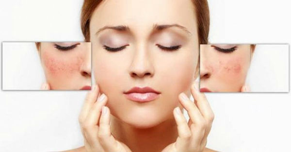 cách điều trị nám da