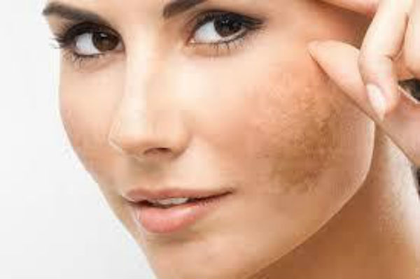cách điều trị nám hiệu quả