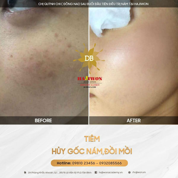 điều trị nám ở đâu