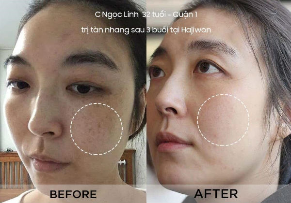 giá điều trị nám da