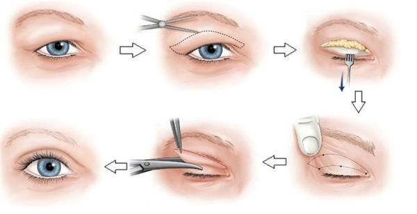 phẩu thuật thẩm mỹ mắt