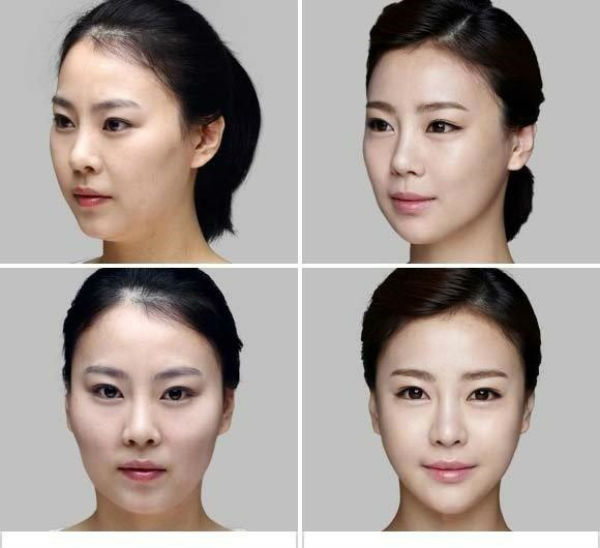 phẩu thuật thẩm mỹ mặt